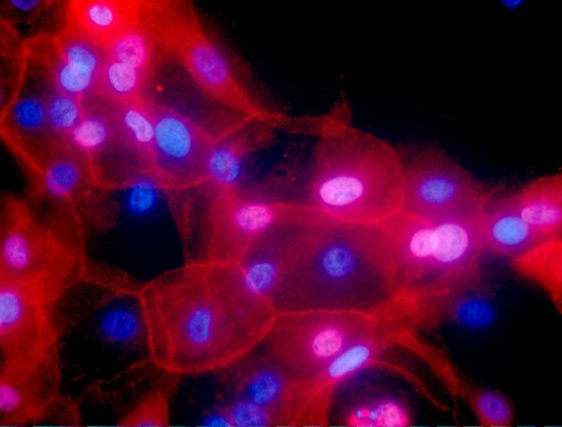 (Ewa Krawczyk/National Cancer Institute via AP). FILE - This undated fluorescence-colored microscope image made available by the National Institutes of Health in September 2016 shows a culture of human breast cancer cells. On Wednesday, Sept. 12, 2018,... (Ewa Krawczyk/National Cancer Institute via AP). FILE - This undated fluorescence-colored microscope image made available by the National Institutes of Health in September 2016 shows a culture of human breast cancer cells. On Wednesday, Sept. 12, 2018,...