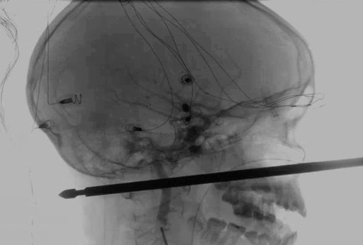 (Medical News Network via AP). This X-ray provided by the Medical News Network shows a meat skewer impaled in the skull of Xavier Cunningham after an accident at his home Saturday, Sept. 8, 2018, in Harrisonville, Mo. Cunningham's experience began when... (Medical News Network via AP). This X-ray provided by the Medical News Network shows a meat skewer impaled in the skull of Xavier Cunningham after an accident at his home Saturday, Sept. 8, 2018, in Harrisonville, Mo. Cunningham's experience began when...