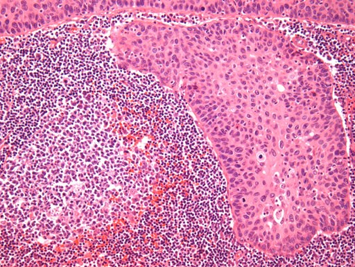 (NewYork-Presbyterian/Columbia University Irving Medical Center). This undated microscope image provided by the NewYork-Presbyterian/Columbia University Irving Medical Center in October 2018 shows squamous cell carcinoma of the cervix, the most common ... (NewYork-Presbyterian/Columbia University Irving Medical Center). This undated microscope image provided by the NewYork-Presbyterian/Columbia University Irving Medical Center in October 2018 shows squamous cell carcinoma of the cervix, the most common ...